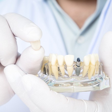Man in white gloves holding sample dental crown and implant in transparent model jaw