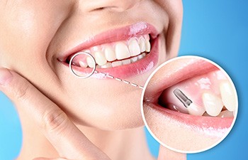Nose-to-neck closeup of woman smiling with one tooth indicated as an implant