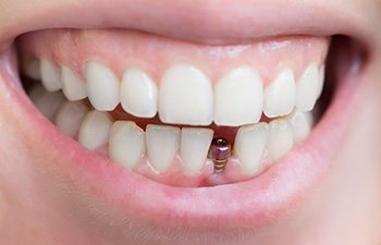 Closeup of a dental implant