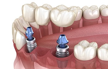 Illustration of an implant bridge