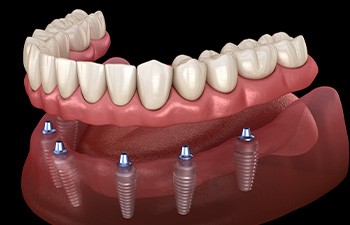 Illustration of an implant denture
