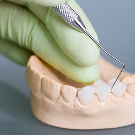 Gloved hand poking dental bridge on model teeth