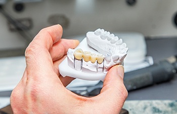 Hand holding cast of teeth with dental bridge placed on it