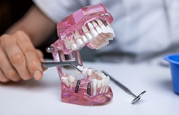 Hands using instrument to lift dental bridge from model implants