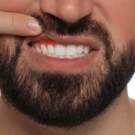 Man lifting his lip to reveal red, swollen gums
