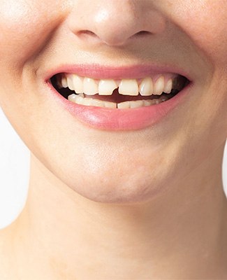 We can restore broken teeth and cavities near Tewksbury