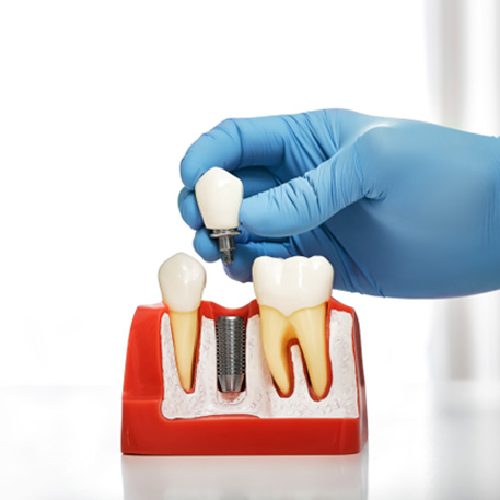 The four step dental implant process is a rewarding journey towards restoring your smile