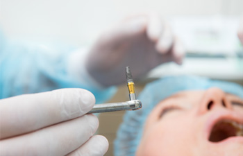 Dental implant surgery is an important step in the dental implant process