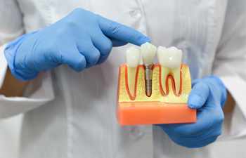 Osseointegration is when your dental implant fuses with your jawbone