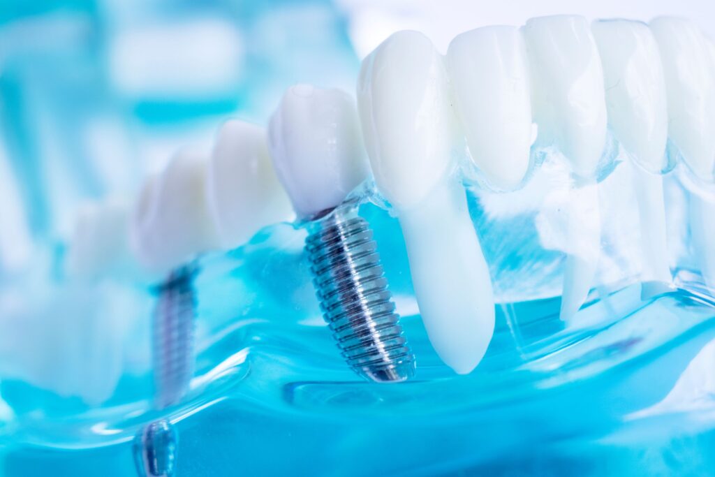 Two sample dental implants in a clear model jaw