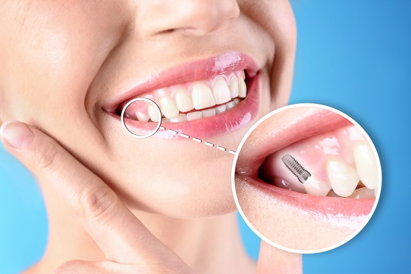 An image highlight and emphasizing a woman’s completed dental implant